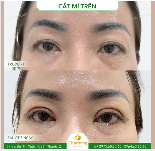 Trước khi thực hiện phẫu thuật, nàng khách gặp phải tình trạng mí lót nhiều và không đều, khiến đôi mắt trông thiếu sức sống và kém phần sắc nét.