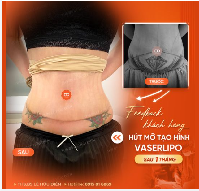 FEEDBACK KHÁCH HÀNG SAU 1 THÁNG HÚT MỠ TẠO HÌNH VASERLIPO TẠI DRD.