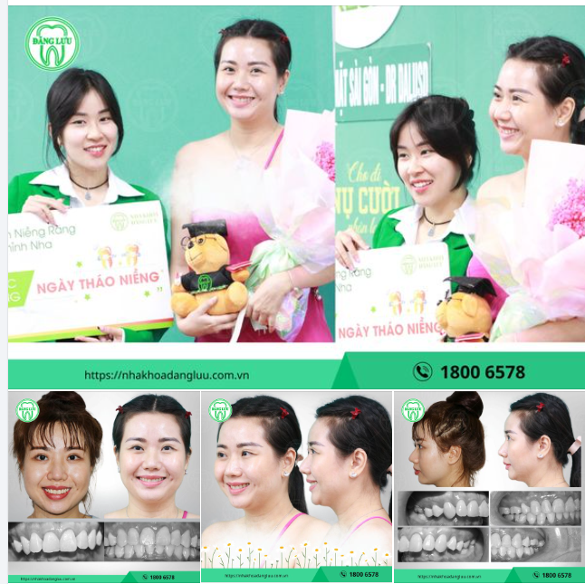 Em xinh, Em xinh, Em xinh đẹp và lung linh... Rạng rỡ như chị Kim Mỹ trong NGÀY THÁO NIỀNG tại Nha Khoa Đăng Lưu!!!