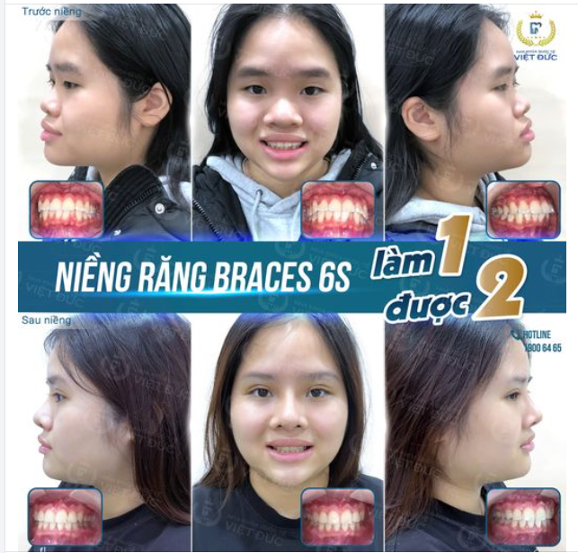 NIỀNG RĂNG - SỞ HỮU GÓC NGHIÊNG HOÀN HẢO