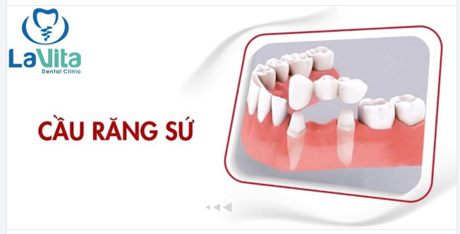 Cầu răng sứ là phương pháp phục hình răng đã mất, được chỉ định trong trường hợp cần thay thế một hoặc 2 răng.