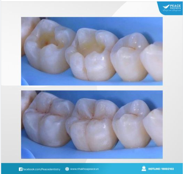 RĂNG SÂU NGHIÊM TRỌNG & CÁC GIẢI PHÁP PHỤC HỒI HIỆU QUẢ
