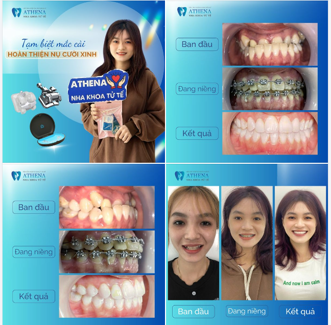 Cảm nhận sau khi tháo niềng: