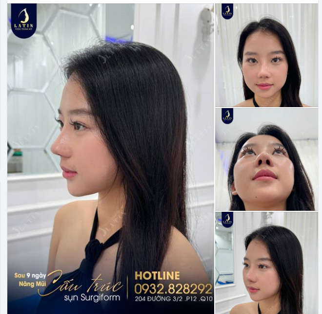 Từ Úc về Việt Nam nâng mũi và cái kết vượt ngoài mong đợi