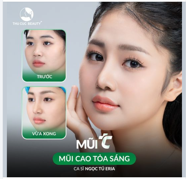 Chị em đã sẵn sàng chinh phục mọi ánh nhìn với nâng mũi giá siêu ưu đãi chưa?