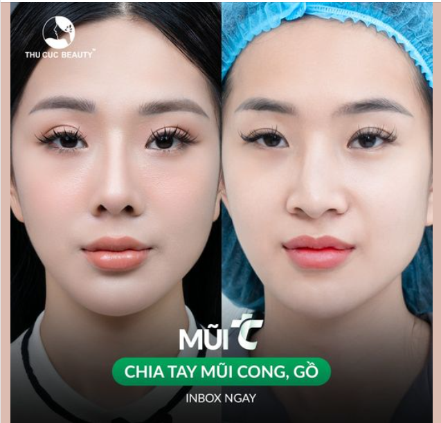 15 phút chia tay mũi cong, gồ