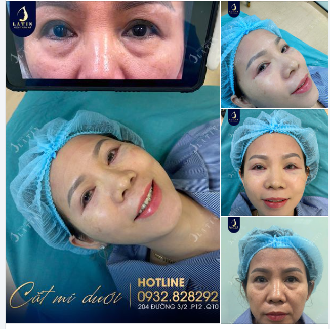 CẮT MÍ DƯỚI - Lấy lại đôi mắt trẻ trung, xinh đẹp cho chị em