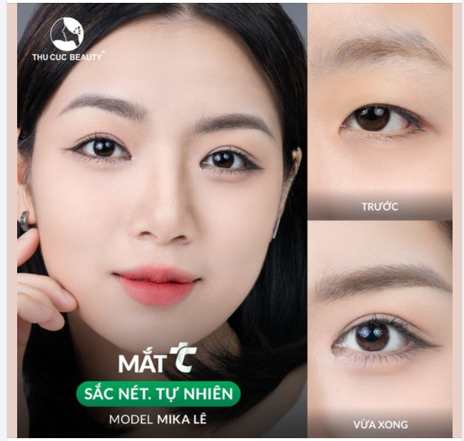 Hối hận vì không đến TC cắt mí sớm hơn