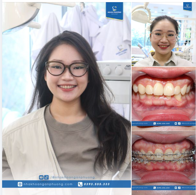 Mai Chi ơi, sắp tháo niềng rồi