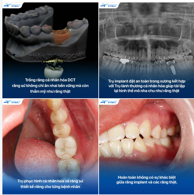 CẬN CẢNH RĂNG IMPLANT ĐƯỢC ỨNG DỤNG GIẢI PHÁP TRỒNG RĂNG CÁ NHÂN HÓA DCT - TẠI NHA KHOA LẠC VIỆT INTECH