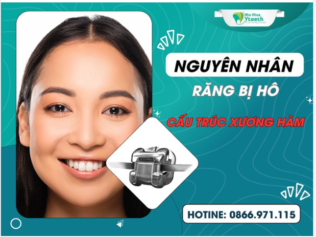 Nguyên nhân răng bị hô - Do cấu trúc xương hàm