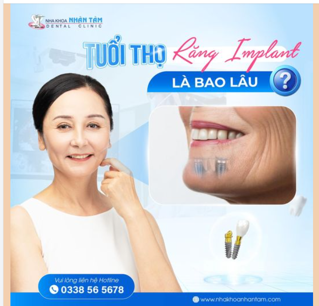 Một trong những lo ngại lớn nhất của nhiều người khi trồng răng Implant chính là tuổi thọ của phương pháp này.