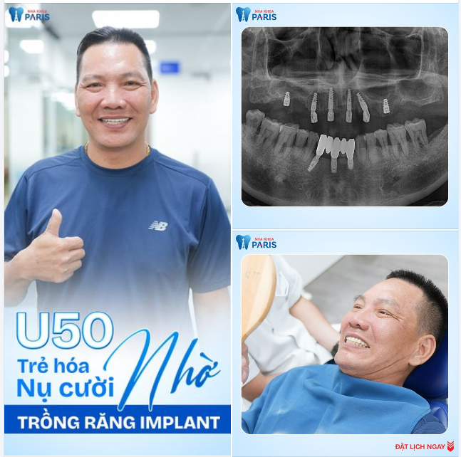 U50 TRẺ HÓA NỤ CƯỜI NHỜ TRỒNG RĂNG IMPLANT