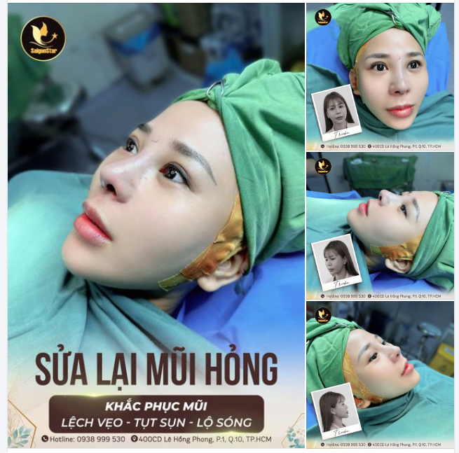TIẾP TỤC CHUYÊN MỤC FLEXING DÁNG MŨI CẤU TRÚC SỬA LẠI CỦA NHÀ BÁC SĨ HOẠT ĐÂY!!!