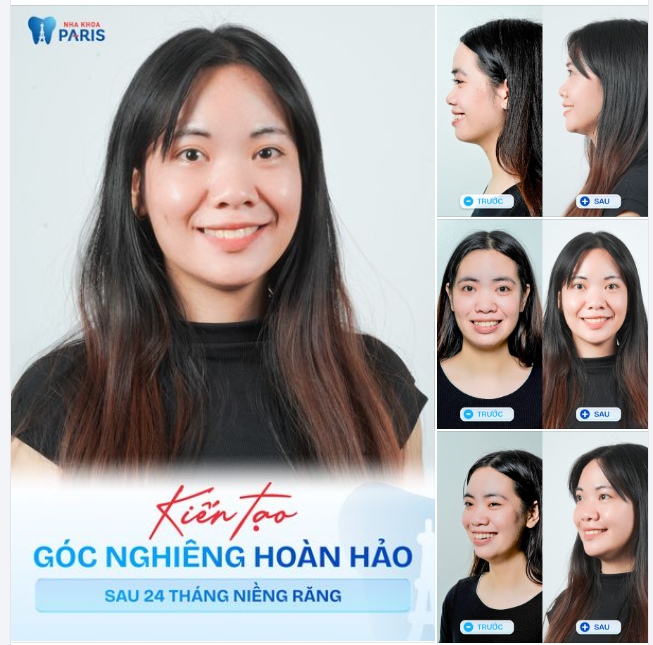 Chúc mừng KH. Quỳnh Trang tháo niềng thành công!