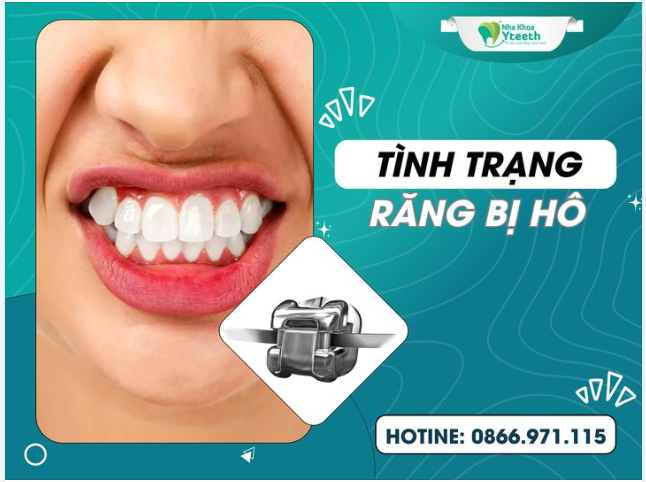 TÌNH TRẠNG RĂNG HÔ - THẾ NÀO LÀ RĂNG BỊ HÔ