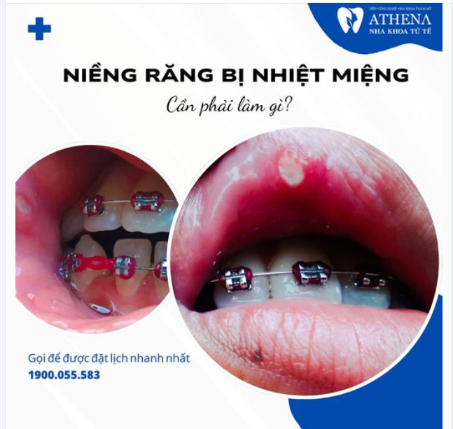 Nhiệt miệng khi niềng răng nên làm gì?