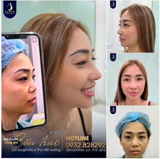 Những hình ảnh cận cảnh mũi cấu trúc 3 tuần tuổi của chị khách Việt kiều