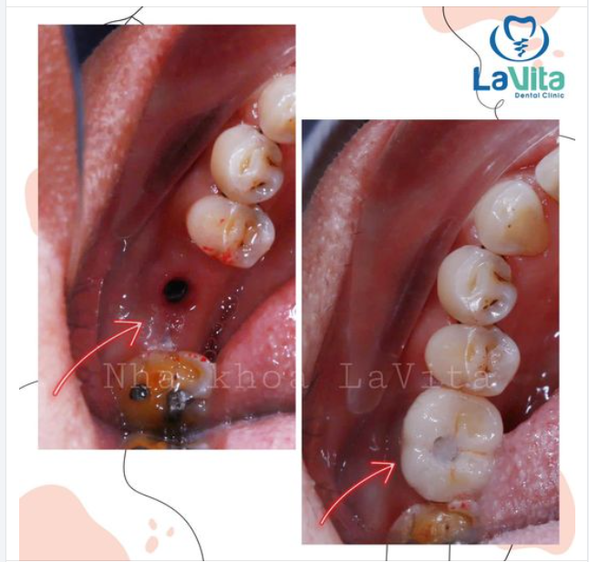 RĂNG IMPLANT CÓ TUỔI THỌ BAO LÂU?