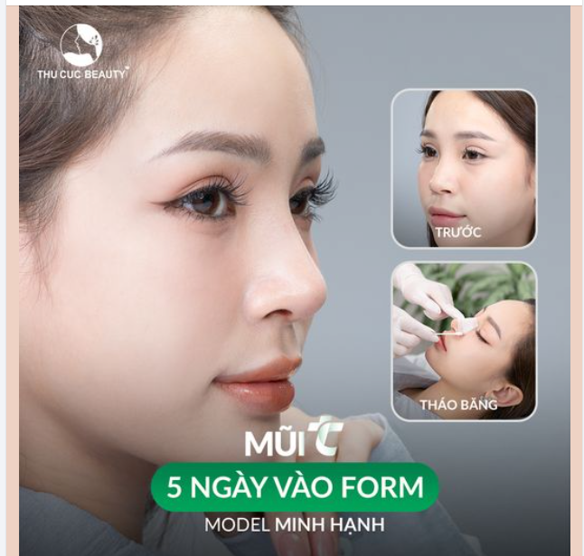 Nâng mũi MODEL Minh Hạnh