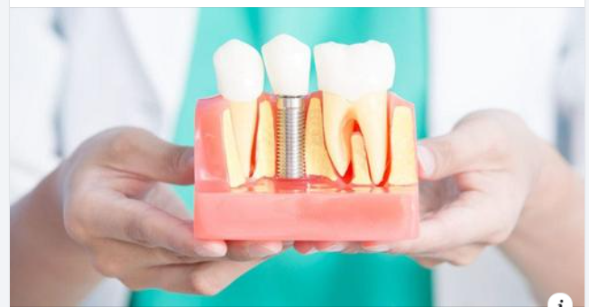 9 lợi ích của việc cấy ghép Implant