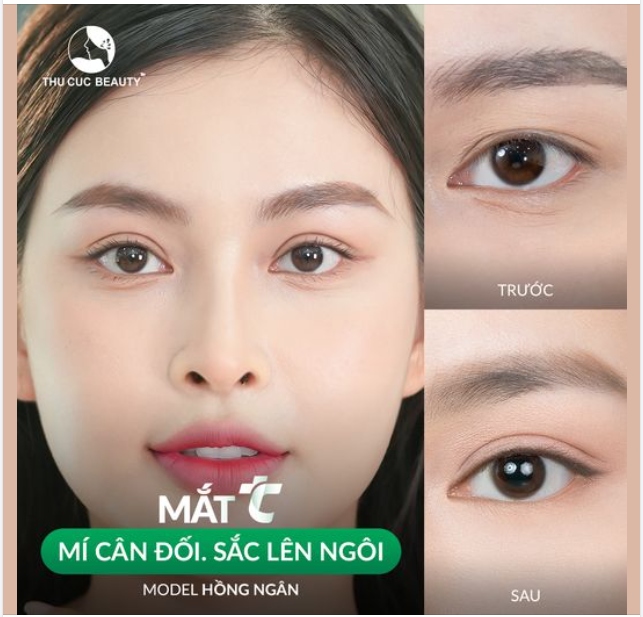 Thật tuyệt vời khi  nhận "Bão" like với nếp mí sau 1 tháng của Model Hồng Ngân