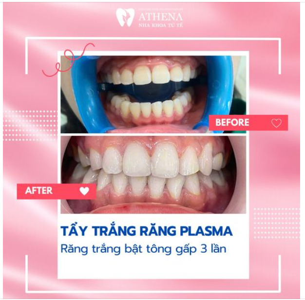 Công nghệ tẩy trắng răng Plasma hiện đại nhất tại Nha Khoa ATHENA mang lại nụ cười trắng sáng chỉ trong 30 phút: