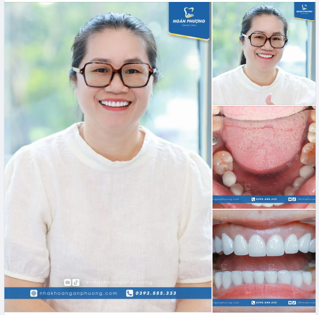 Implant và răng sứ có làm cùng lúc được không?