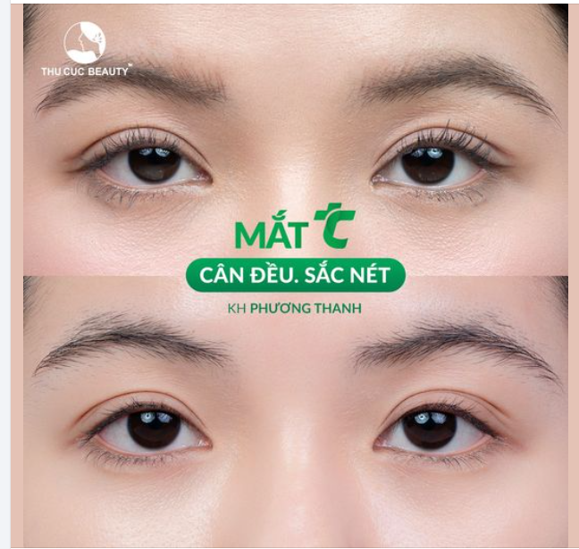 Cắt mí cho khách hàng Phương Thanh