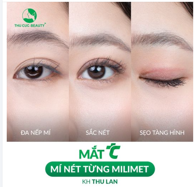Mí mắt đẹp chuẩn cho khách hàng Thu Lan