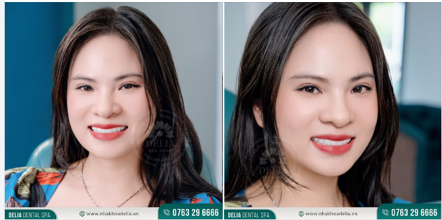 SỞ HỮU NỤ CƯỜI "XINH ĐẸP - RẠNG RỠ" SAU 48H BỌC RĂNG SỨ TẠI DELIA