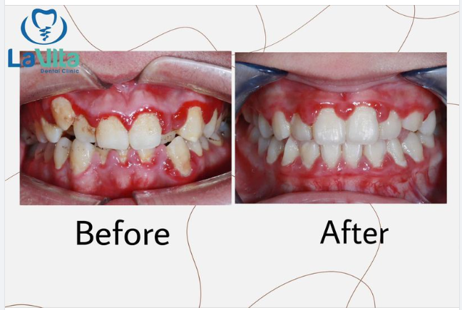 TÌM HIỂU VỀ VIÊM LỢI TUỔI DẬY THÌ: TRIỆU CHỨNG, CÁCH ĐIỀU TRỊ