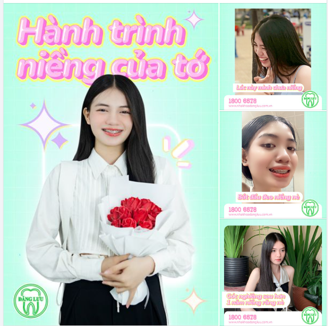 Chia sẻ của Bích Tiền sau hơn 1,5 năm niềng răng
