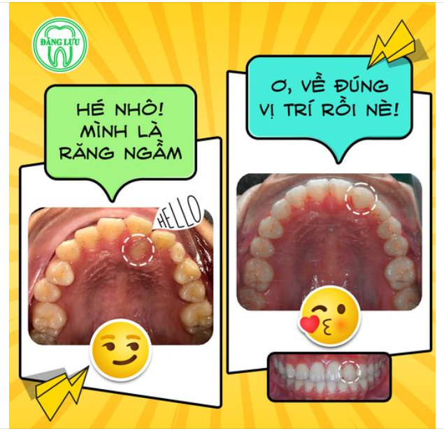Răng ngầm kiểu: "Bảnh đã trốn kỹ thế này rồi mà Bác sĩ Phó Khoa Chỉnh Nha tại Nha Khoa Đăng Lưu còn kéo Bảnh ra được nữa chớ"