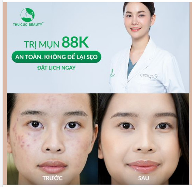 Mụn ẩn - Mụn viêm - Mụn trứng cá Đến Thu Cúc trị mụn ngay