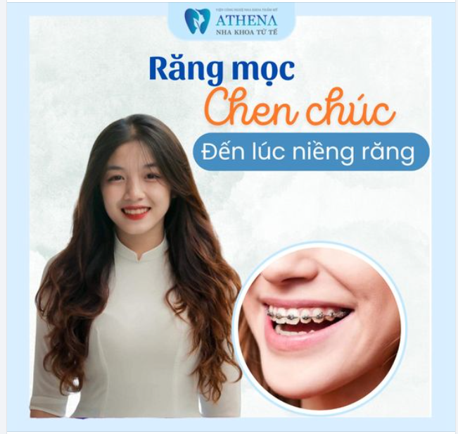 RĂNG MỌC CHEN CHÚC - ĐẾN LÚC NIỀNG RĂNG