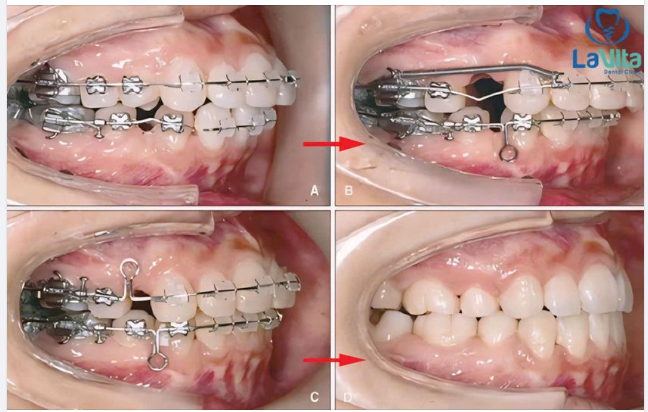 Rất nhiều khách hàng có tâm lý e ngại khi được chỉ định nhổ răng trong quá trình chỉnh nha.