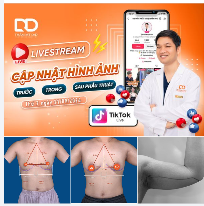BẢN TIN CUỐI TUẦN Cập nhật nhanh lịch phẫu thuật hôm nay: 3 ca Nâng V1 + 1 ca Hút mỡ tay Vaserlipo + 2 ca Nâng mũi