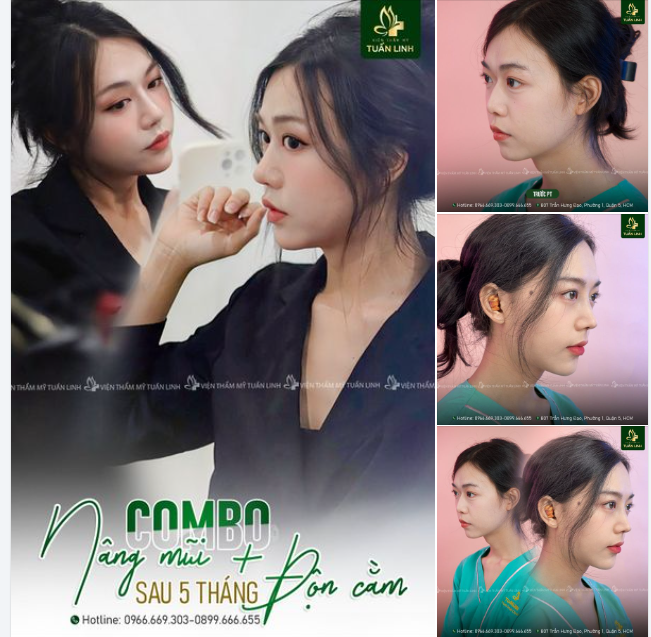 Nâng mũi + Độn cằm Kiến tạo nét đẹp thanh tú cho gương mặt!!