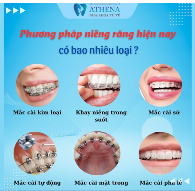 PHƯƠNG PHÁP NIỀNG RĂNG HIỆN NAY CÓ BAO NHIÊU LOẠI?