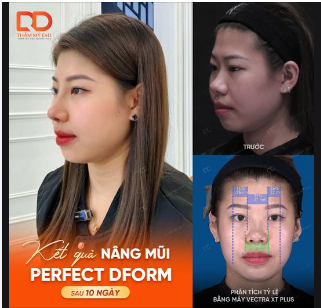 HOÀN THIỆN GÓC NGHIÊNG - TỰ TIN VỚI DIỆN MẠO MỚI SAU 10 NGÀY NÂNG MŨI PERFECT DFORM