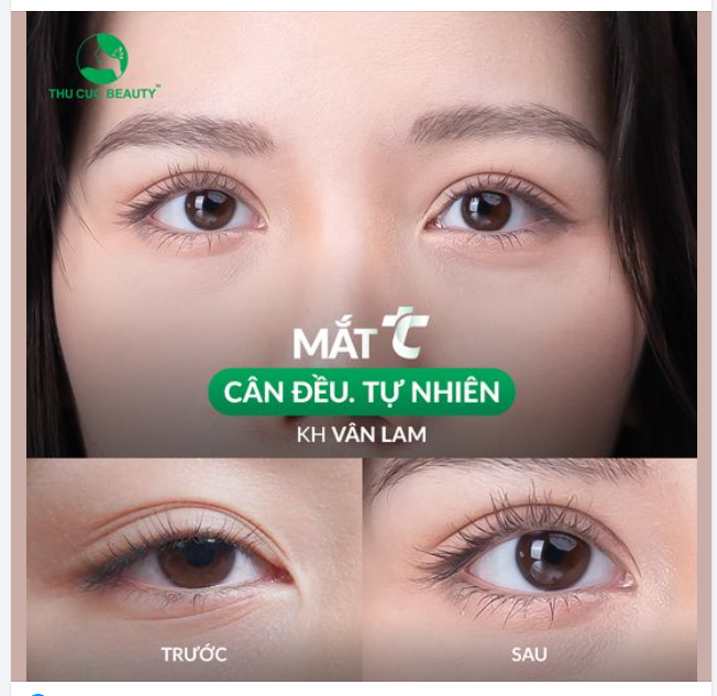 Không còn đôi mắt lờ đờ sau 15 phút cắt mí TC