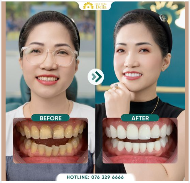 ĐỔI RĂNG NHIỄM MÀU, THƯA KẼ ​​​​​​​ LẤY RĂNG SỨ KHỎE ĐẸP