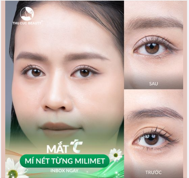 Đa nếp mí khiến mắt lờ đờ, mệt mỏi Lựa chọn Mắt TC ngay
