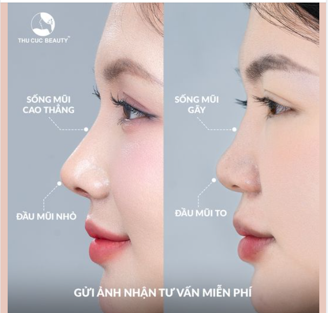 Chiếc mũi đẹp chuẩn nét vàng của Model Thùy Vy là lý do mà nhiều bạn bè cũng nối gót cô gái này đi nâng mũi tại Thu Cúc
