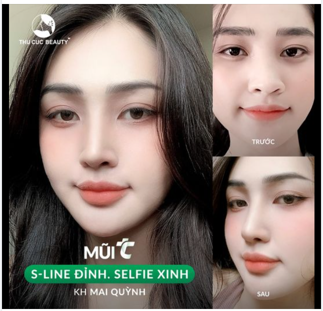 Nâng mũi Sline đỉnh của chóp