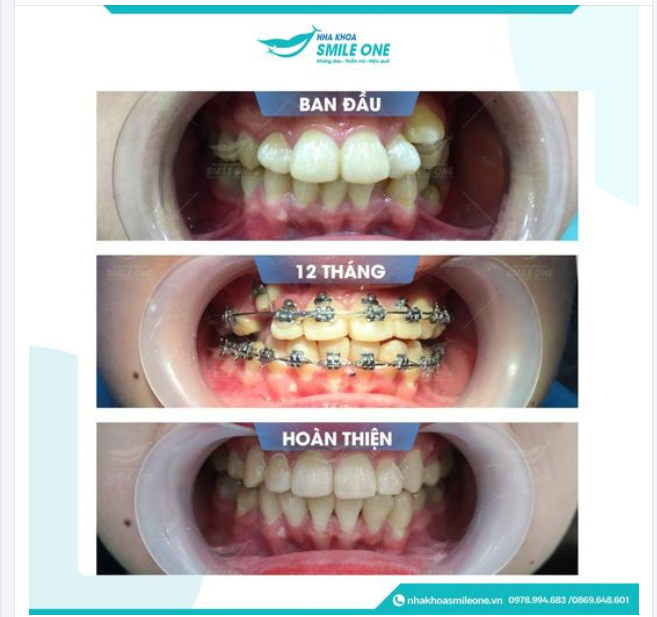 16 THÁNG NIỀNG RĂNG KHẮC PHỤC RĂNG HÔ, KHẤP KHỂNH