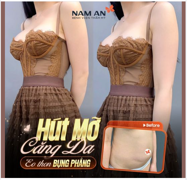 HÚT MỠ CĂNG DA - EO THON BỤNG PHẲNG.
