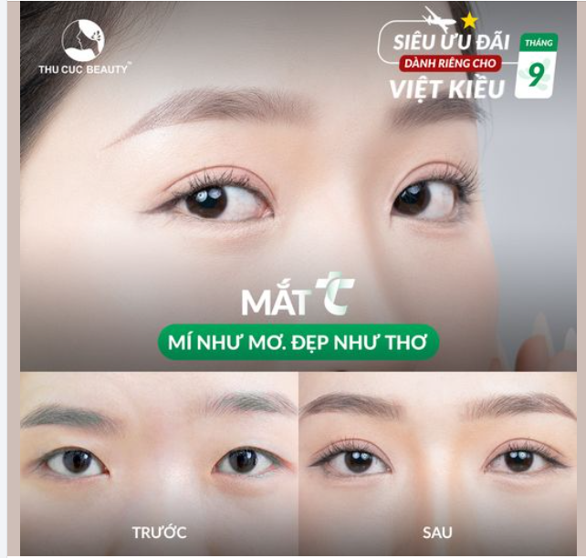 Việt Kiều về nước nên Cắt mí ở đâu?