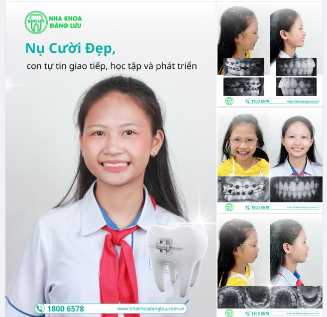 NIỀNG RĂNG TĂNG TRƯỞNG - Cho bé nụ cười đẹp tự tin từ sớm, thoải mái học tập, giao tiếp